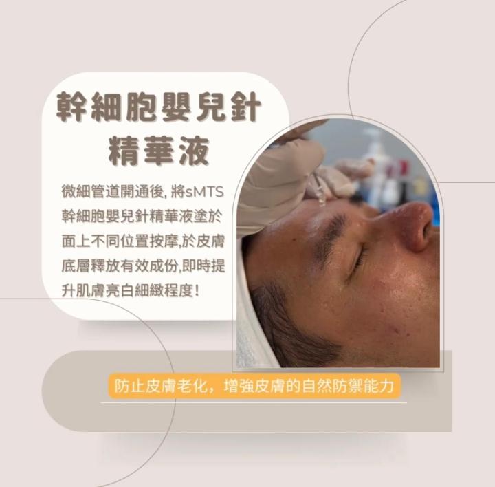 要先將黑頭油脂浮上表面,令到之後針清容易處理