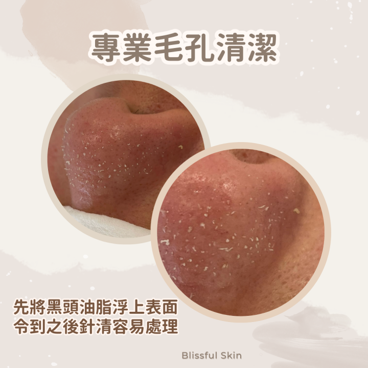 要先將黑頭油脂浮上表面,令到之後針清容易處理