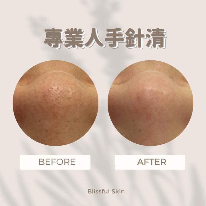 清除皮膚表層老廢角質、油脂