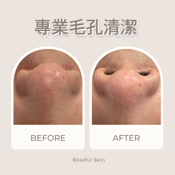 療程唔單止可以清潔毛孔,仲可以舒緩皮膚,令皮膚更加亮麗