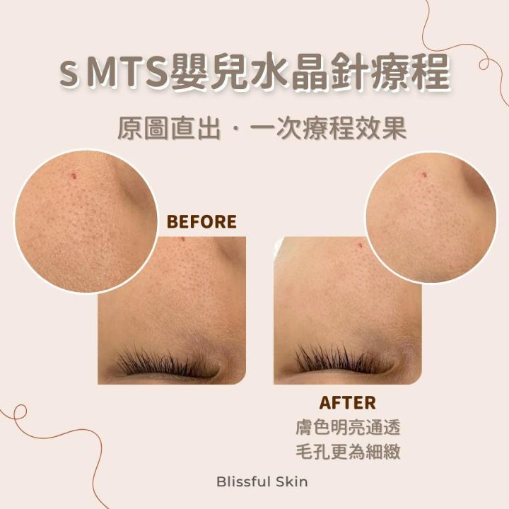 要先將黑頭油脂浮上表面,令到之後針清容易處理