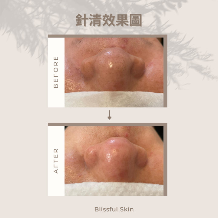 深入清潔底層的污垢、黑頭、粉刺