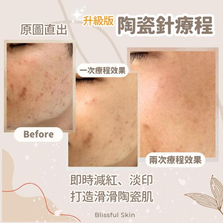 專業毛孔清潔幫你層層清潔重拾健康光澤