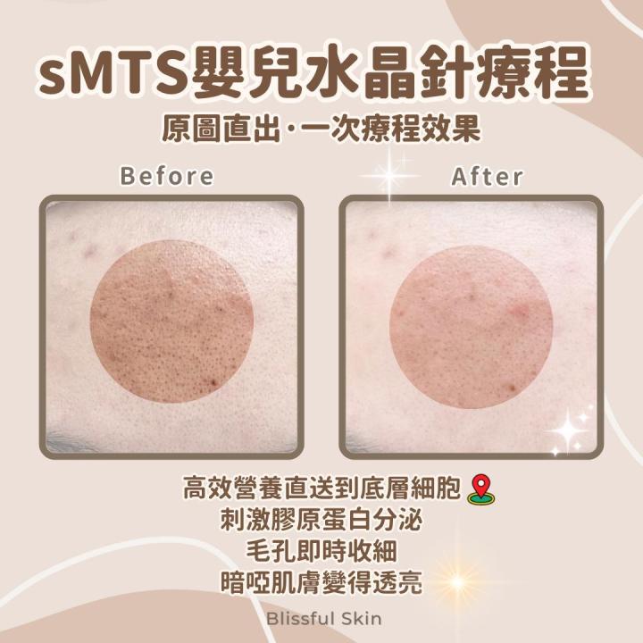 專業毛孔清潔幫你層層清潔重拾健康光澤